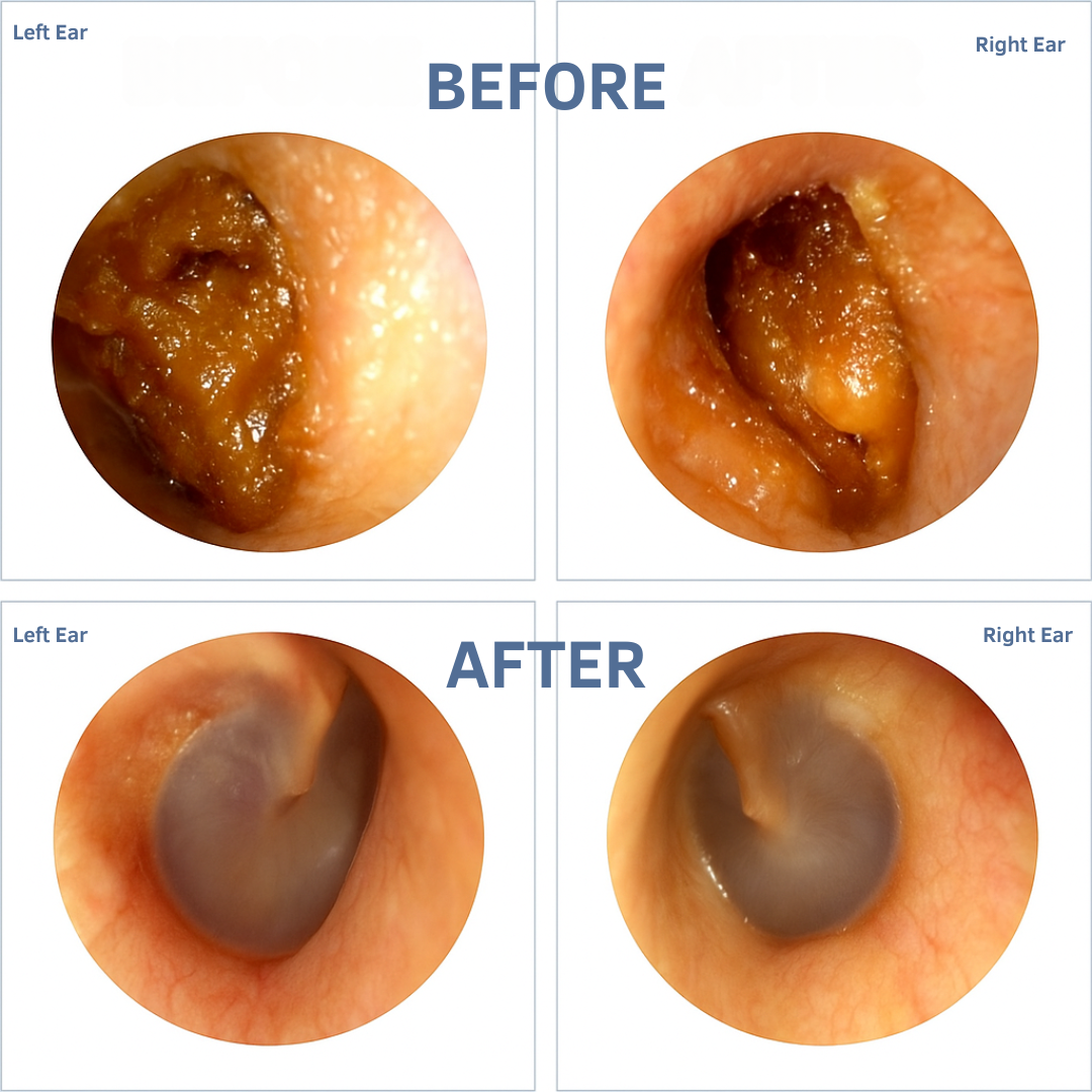 WaxClean™ - Smart Ear Cleaning With Advanced Technology