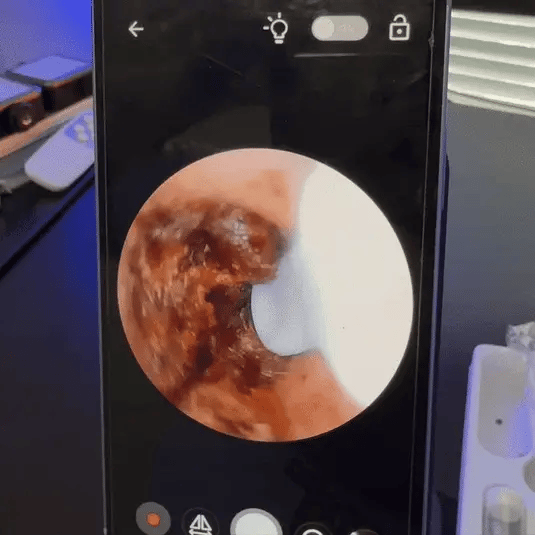 20 Years of Earwax Build-Up